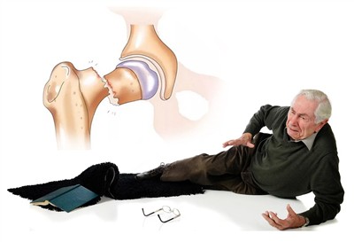 Dlaczego codzienne zachowania prowadzą do częstych złamań u osób starszych